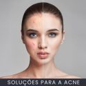 Soluções para a acne curso online