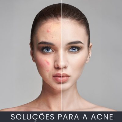 Soluções para a acne curso online