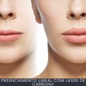 Preenchimento Labial com Laser de Carbono curso online Preenchimento Labial com Laser de Carbono curso online