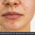 Removedor de manchas CryoPen curso online
