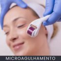 Microagulhamento curso online Microagulhamento curso online