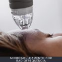 Microagulhamento por Radiofrequência curso online