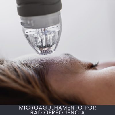 Microagulhamento por Radiofrequência curso online