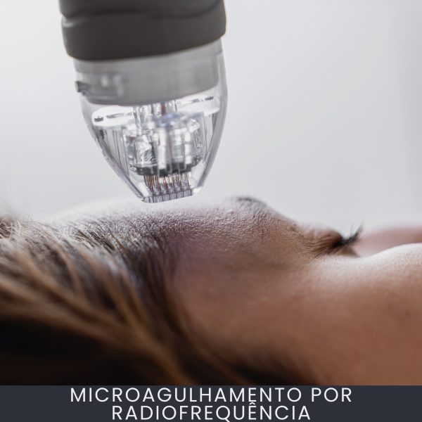 Microagulhamento por Radiofrequência curso online