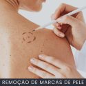 Remoção de sinais da pele curso online