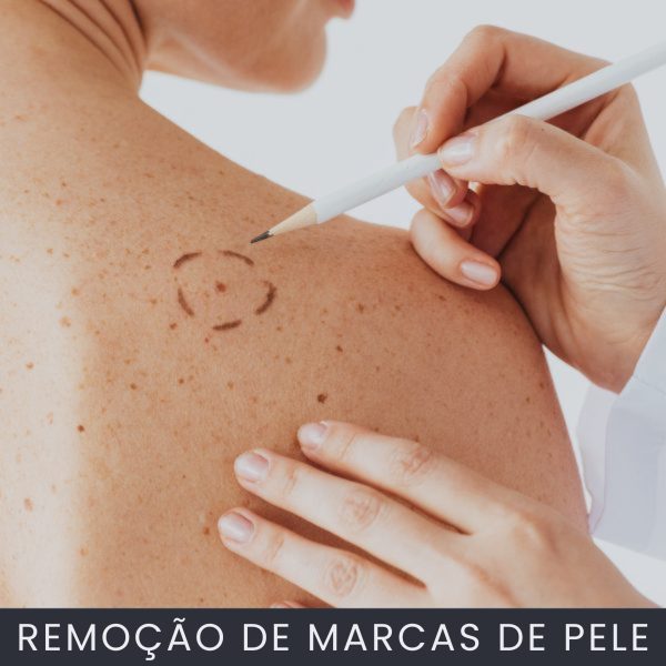 Remoção de sinais da pele curso online
